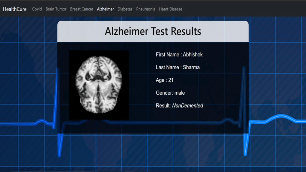 Alzheimer detection Final Year Python Projects